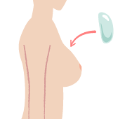 インプラント（人工乳房）法