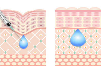 ヒアルロン酸注入