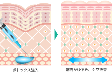 ボトックス