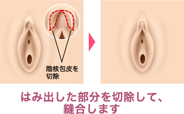 処女破壊出血 処女膜と初体験～よくある質問と疑問を解決します | 銀座みゆき ...