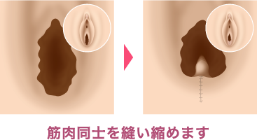 膣縮小手術