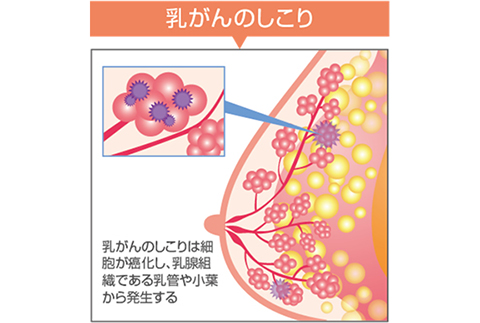 乳がんのしこり
