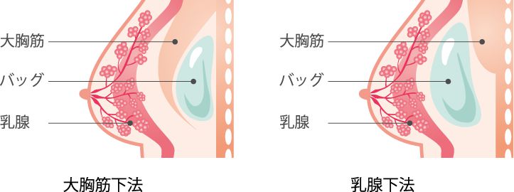 大胸筋下法・乳腺下法