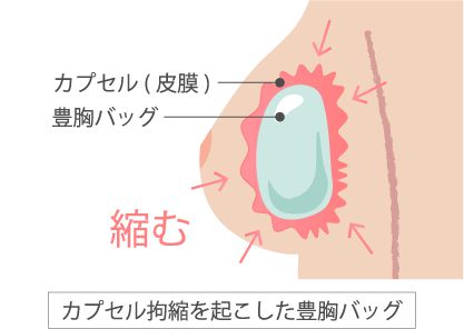 カプセル拘縮