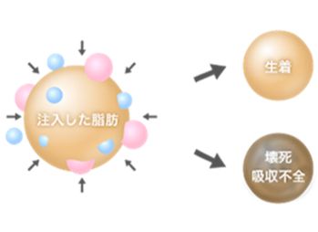 脂肪注入による痛み