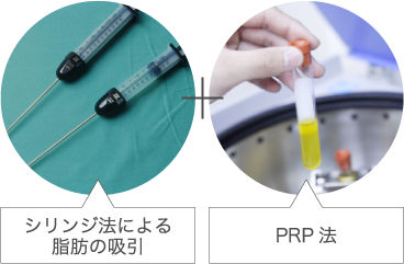 シリンジ法による脂肪吸引・PRP