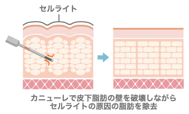 セルライト除去
