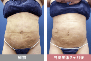 他院修正の症例写真 ベイザー脂肪吸引
