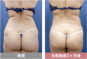 他院修正の症例写真 ベイザー脂肪吸引