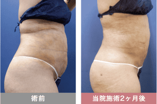 他院修正の症例写真 ベイザー脂肪吸引
