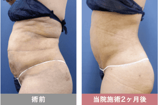 他院修正の症例写真 ベイザー脂肪吸引