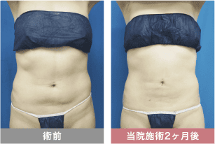 他院修正の症例写真 腹部の脂肪吸引