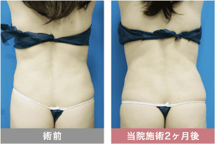 他院修正の症例写真 腹部の脂肪吸引