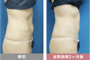 他院修正の症例写真 腹部の脂肪吸引