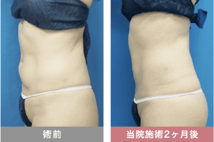 他院修正の症例写真 腹部の脂肪吸引