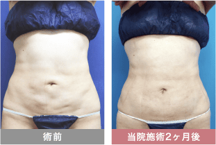 他院修正の症例写真 腹部の脂肪吸引