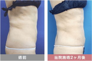 他院修正の症例写真 腹部の脂肪吸引
