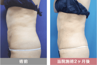他院修正の症例写真 腹部の脂肪吸引