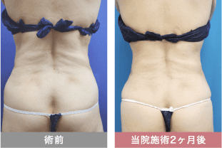 他院修正の症例写真 腹部の脂肪吸引