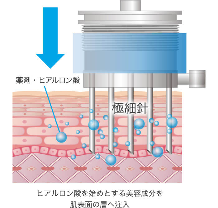 水光注射イメージ