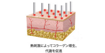 SRR：イントラセルイメージ