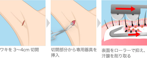 アポクリン腺とエクリン腺を取り除く方法