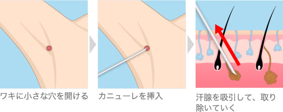 アポクリン腺とエクリン腺を取り除く方法