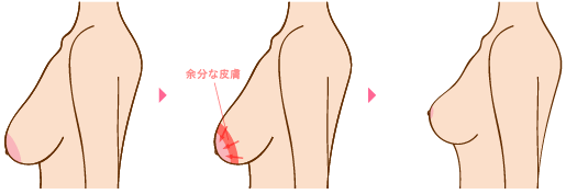 余分な皮膚を取り除く