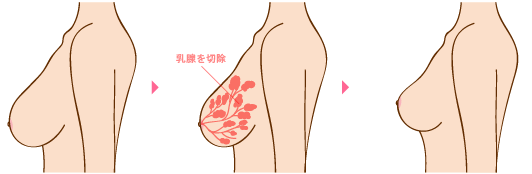 乳腺切除