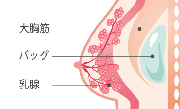 大胸筋下法