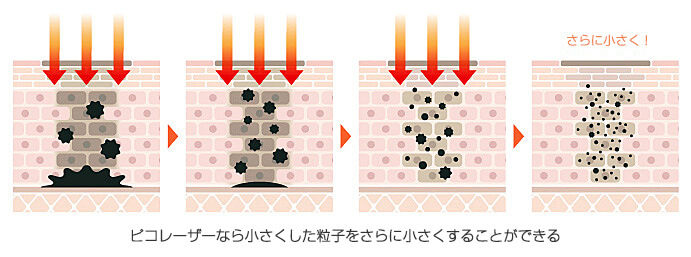 ピコレーザーなら小さくした粒子をさらに小さくすることができる