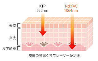 皮膚の奥深くまでレーザーが到達