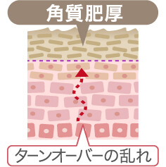 3.「古い角質」が原因