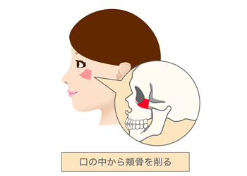 口の中から頬骨を削る