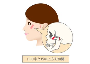 口の中と耳の上方を切開