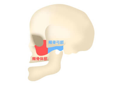 頬骨削り