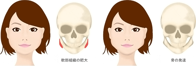 軟部組織の肥大、骨の発達