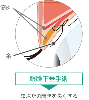 眼瞼下垂手術