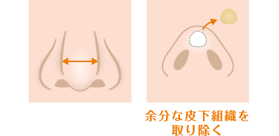 余分な皮下組織を取り除く