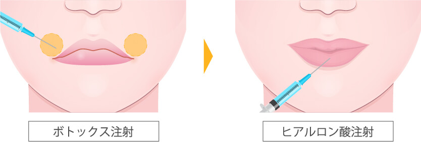 ボトックス・ヒアルロン酸注射