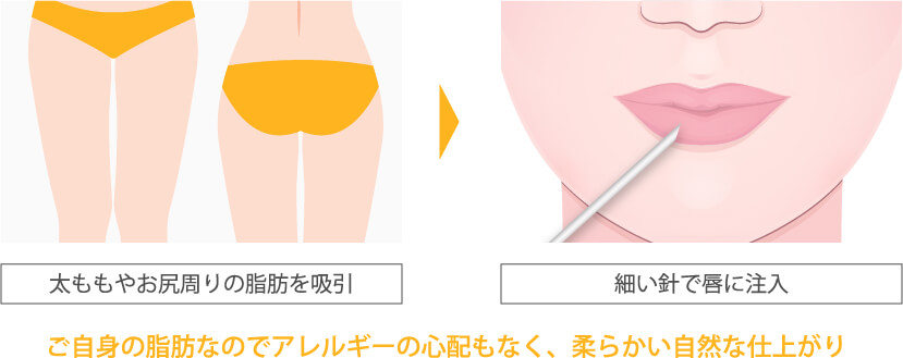 太ももやお尻周りの脂肪を吸引し、細い針で唇に注入