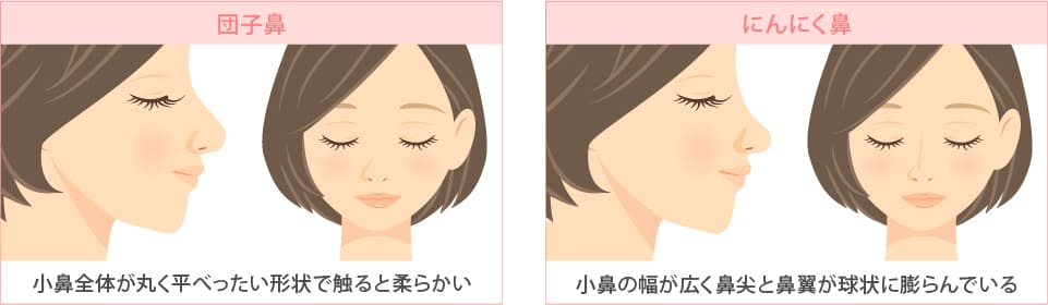 にんにく鼻と団子鼻の違い