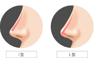 鼻プロテーゼ