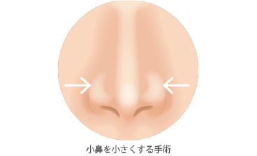 小鼻縮小術
