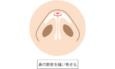 鼻尖形成（耳介軟骨移植）