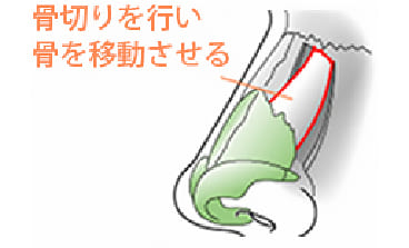 鼻骨骨切り