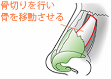 骨切りを行い骨を移動させる