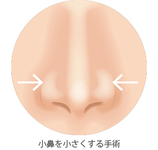 小鼻を小さく