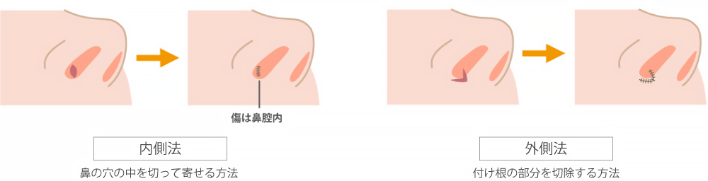 内側法と外側法