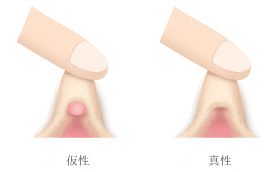 クリトリス包茎